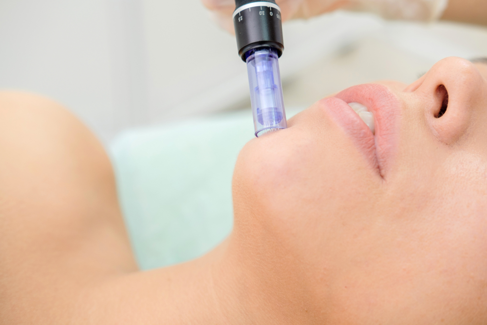 SkinPen Microneedling Treatment in Mary Esther, FL