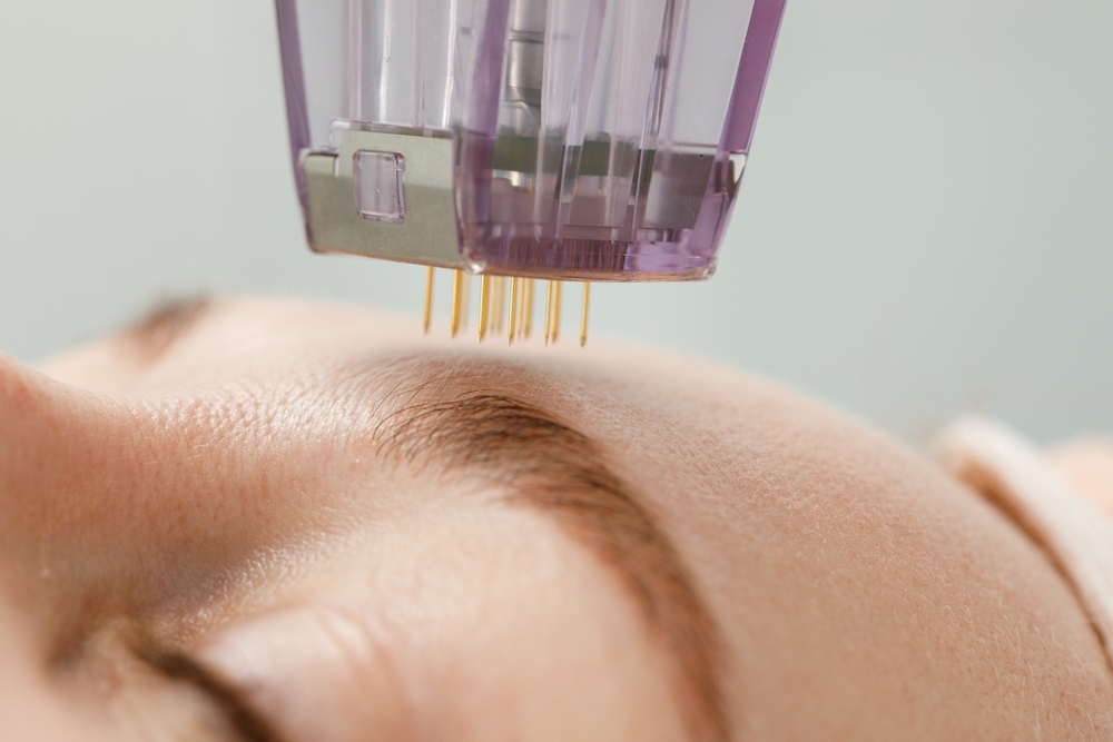 SkinPen Microneedling in Mary Esther, FL